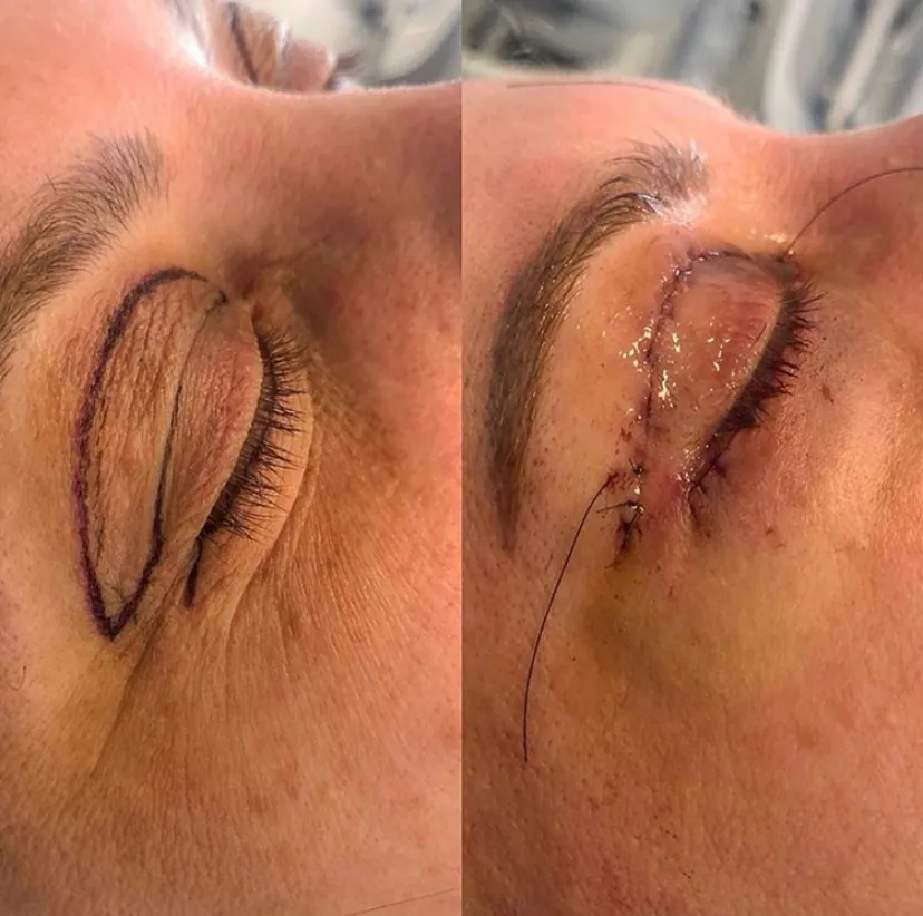 Facial plastic surgery in Bangalore