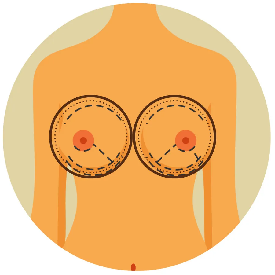 Breast Reduction