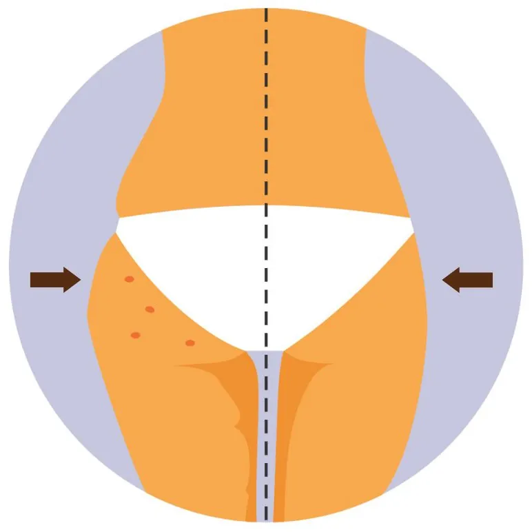 Liposuction
