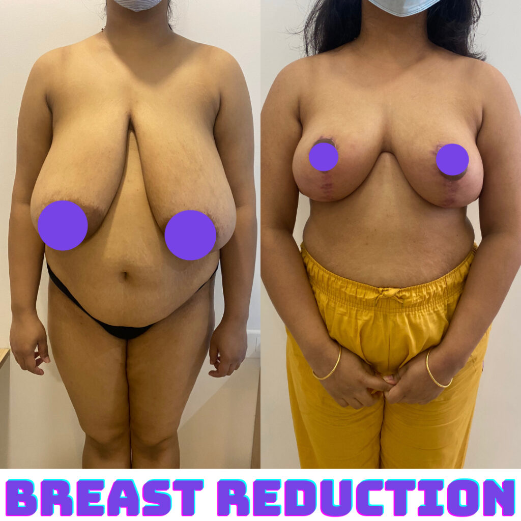 Breast Reduction