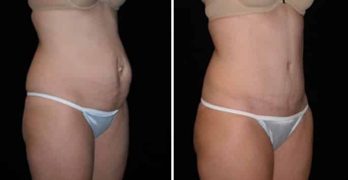 🥇 Tummy Tuck / Abdominoplasty