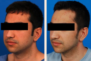 Rhinoplasty Surgery In Bangalore