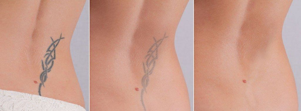 Laser Tattoo Removal | Painless Tattoo Removal | Up to 25% Discount | No  Cost EMI - YouTube