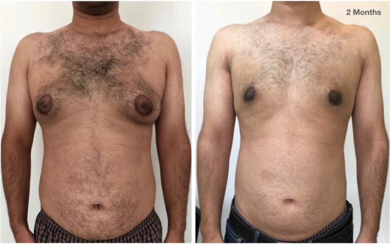 Grade 2B Gynecomastia- Day Care Procedure