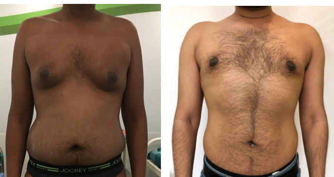 Grade 3 Gynecomastia- Surgery with Skin Tightening