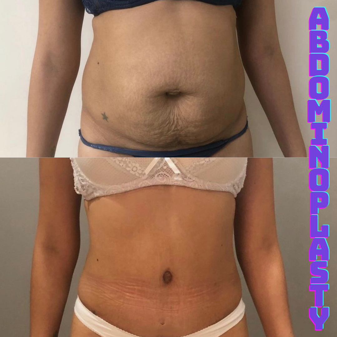 ATIR Tummy Tuck Slip