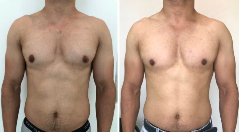 Grade 1 Body builder's gynecomastia