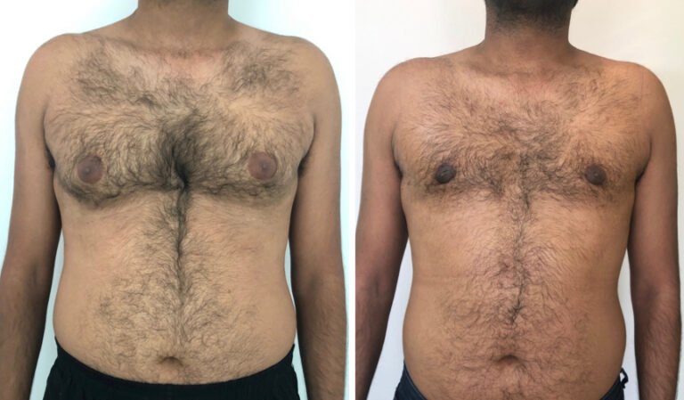 Grade 2A Gynecomastia- Surgery time- 60mins