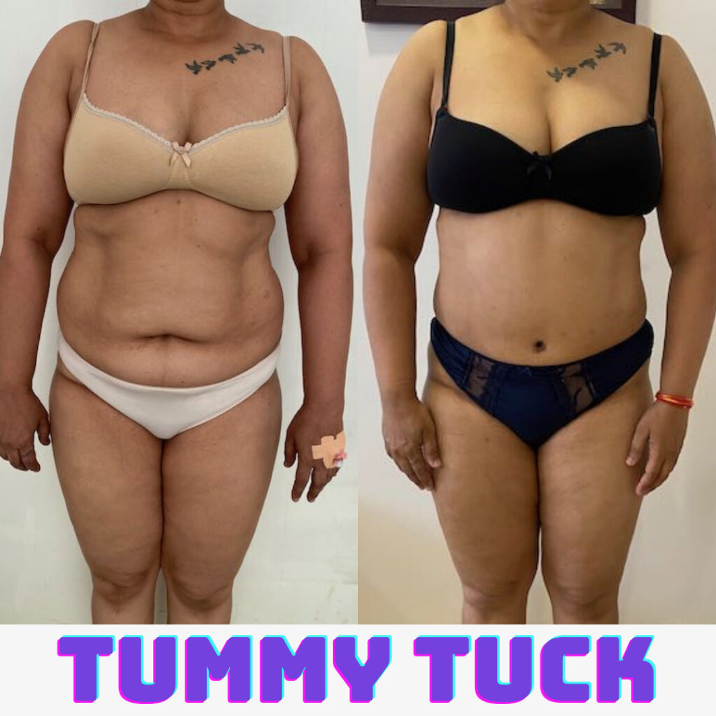 Best Top 3 Mommy Makeover Surgery In Bangalore Thigh Surgery