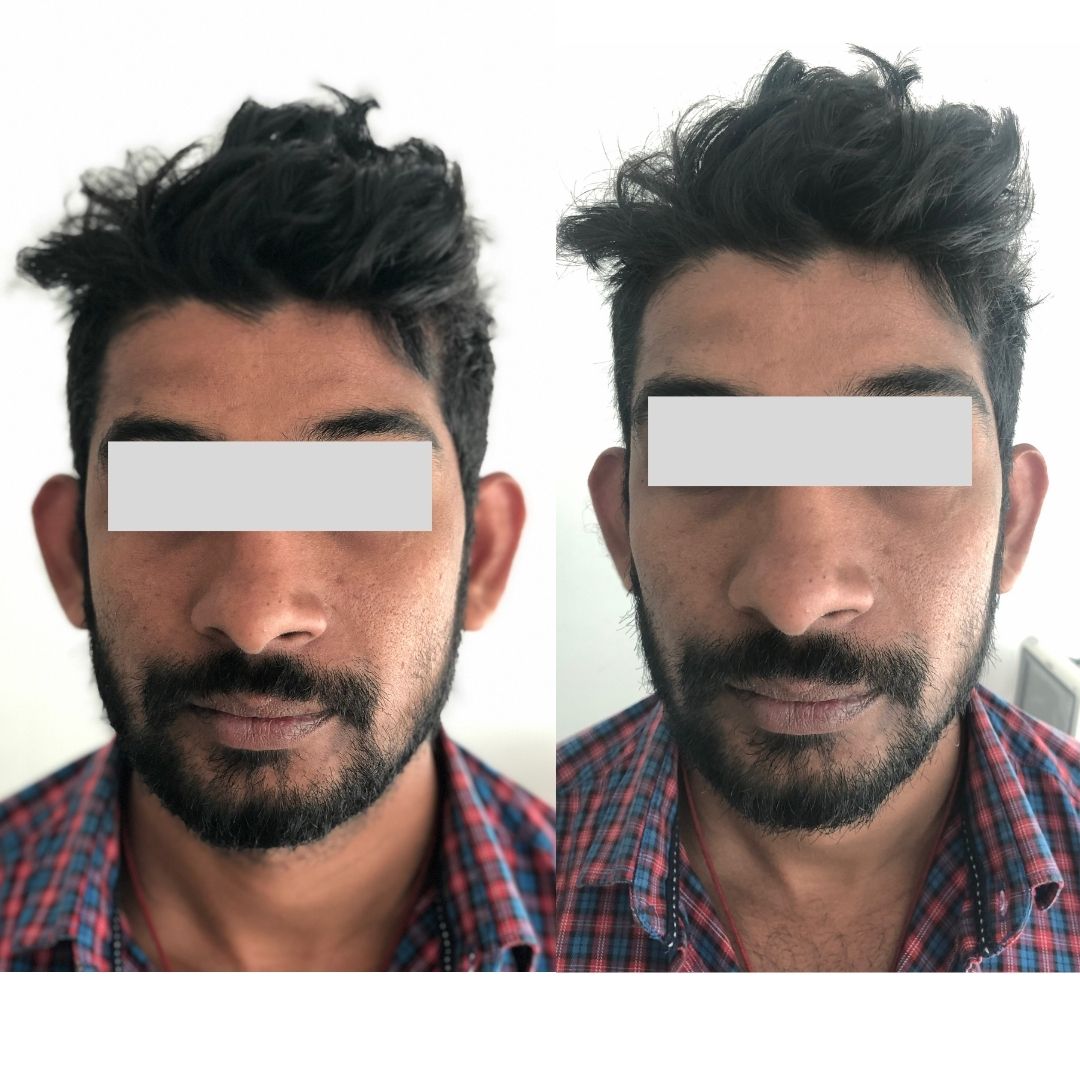 Otoplasty for Prominent Bat Ears Best Plastic Surgery, Dermatology