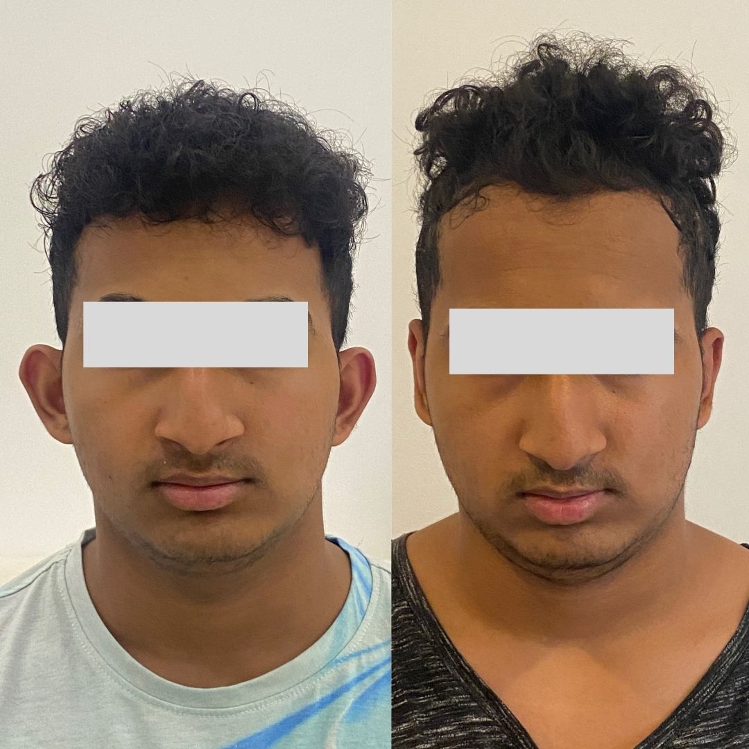 Otoplasty for Prominent Bat Ears Best Plastic Surgery, Dermatology