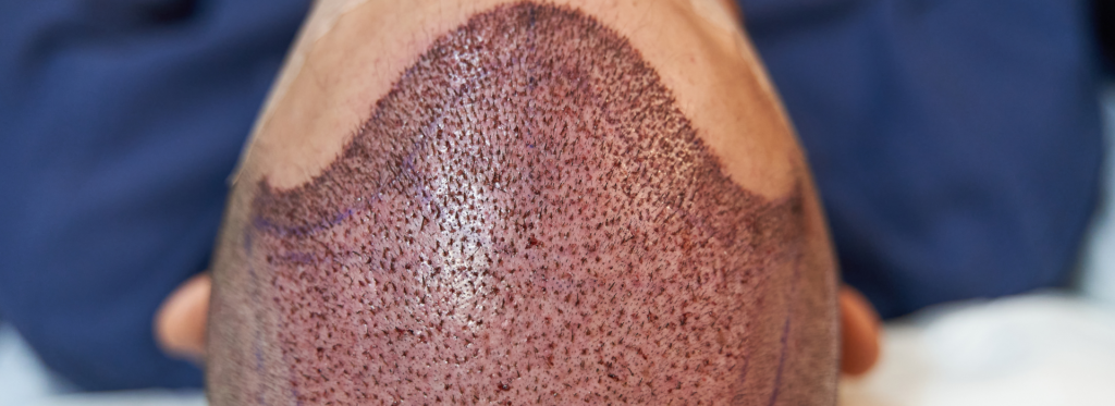 Hair Transplant Surgery in Bangalore