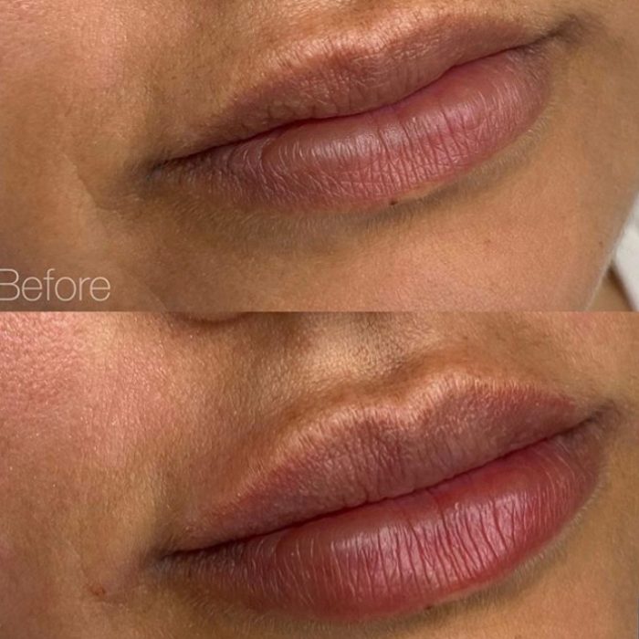 Juvederm for Lips