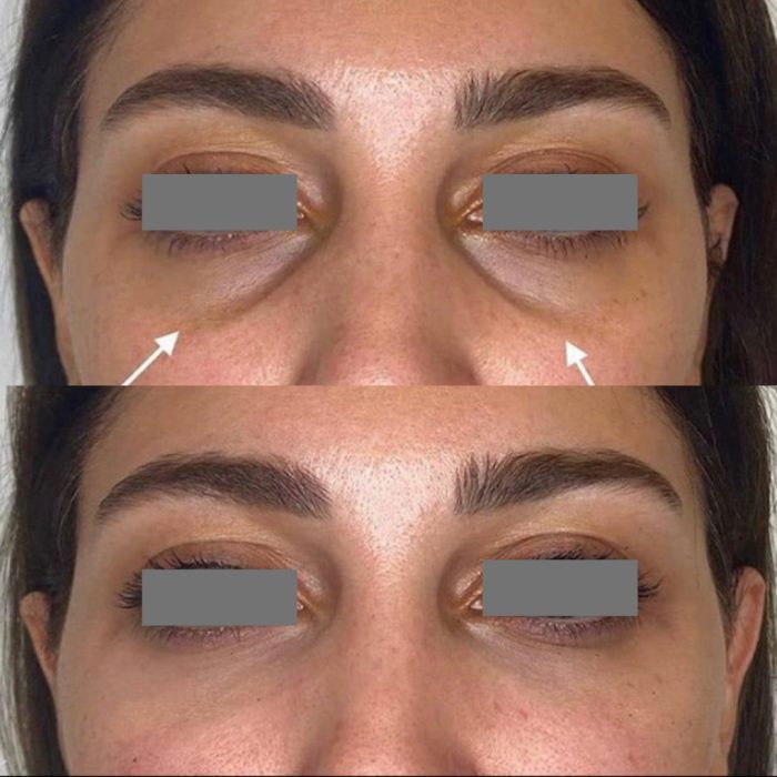 Restylane for Tear Troughs