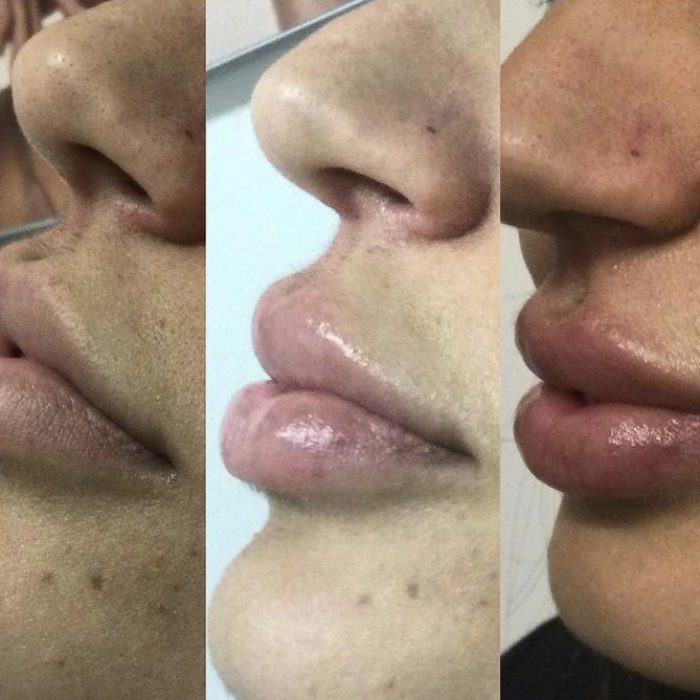 1ml of Restylane for Lips