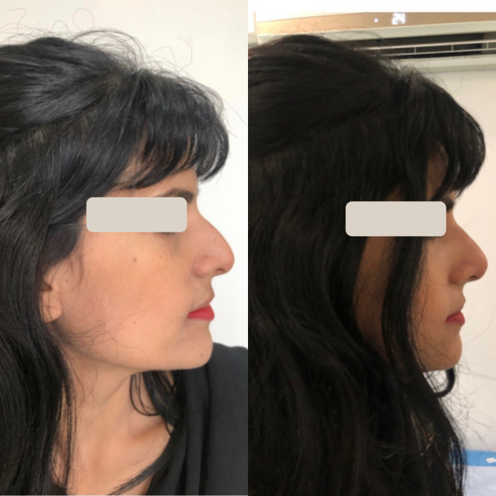 Less than 1ml of Restylane for Nose Reshaping