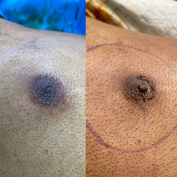 Inverted Nipple Surgery  Best Plastic Surgery, Dermatology & Hair  Transplantation In Bangalore